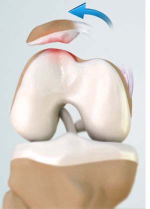 The Knee Resource  Patellar Dislocation & Subluxation